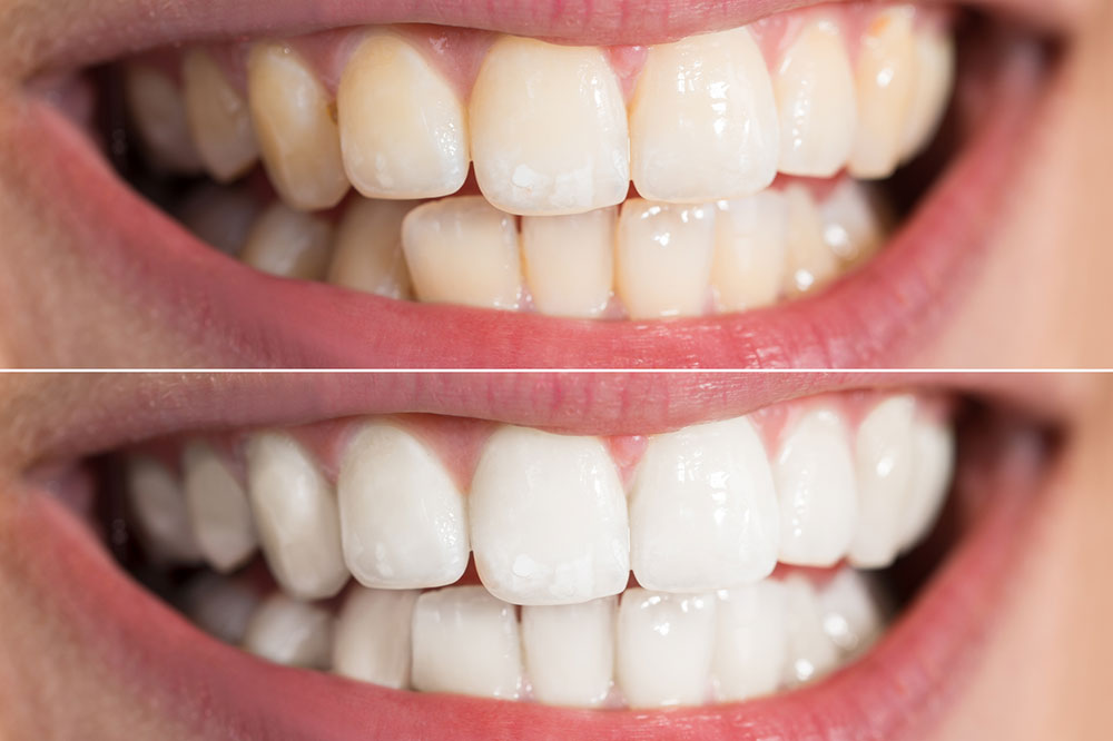4 At-Home Teeth Whitening Methods