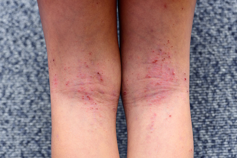 Atopic Dermatitis Aggravators