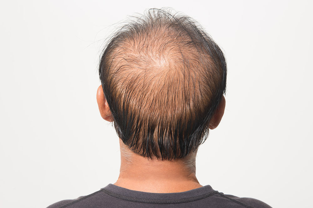 Tips for Preventing or Reducing Male Pattern Baldness
